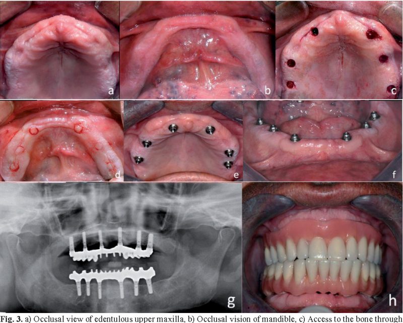 Nha khoa phục hồi với implant
