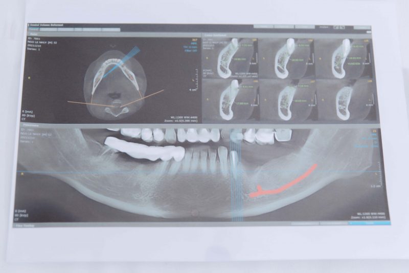 Bệnh nhân được chẩn đoán qua phim CT trước phẫu thuật đặt implant