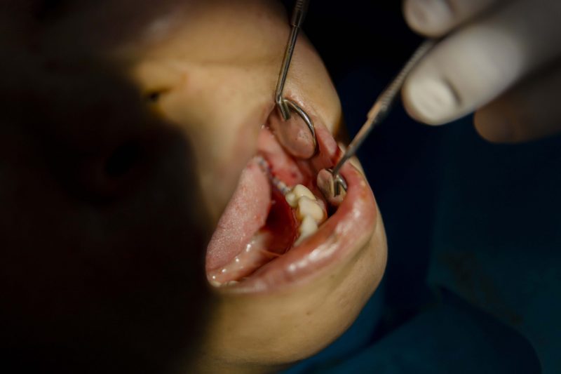 vết thương khô ráo sau phẫu thuật cấy trụ implant