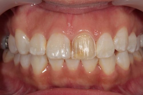 Một trường hợp chỉ định làm mặt sứ veneer