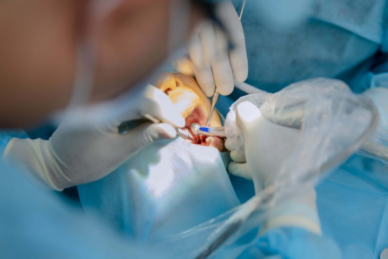 Phẫu thuật đặt trụ Implant