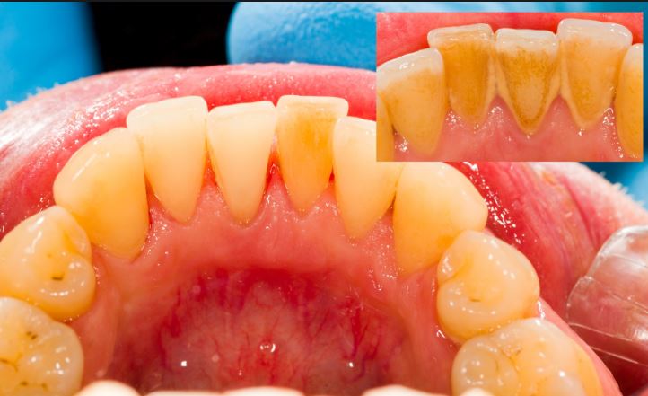 Nguyên nhân răng bị vàng ố