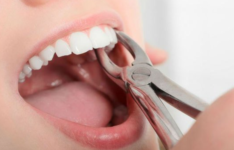 Tiến hành nhổ răng