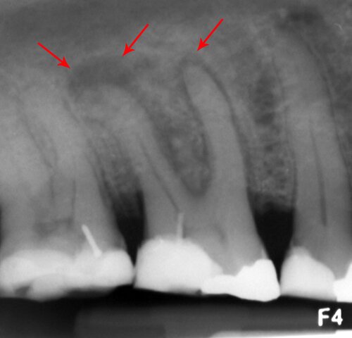Chẩn đoán ổ nhiễm trùng chân răng trên phim X-quang cận chóp