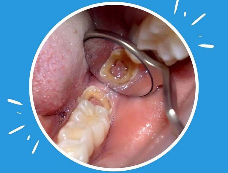 Phần thân và chân răng bị hư tổn nặng, không thể điều trị cần phải nhổ bỏ