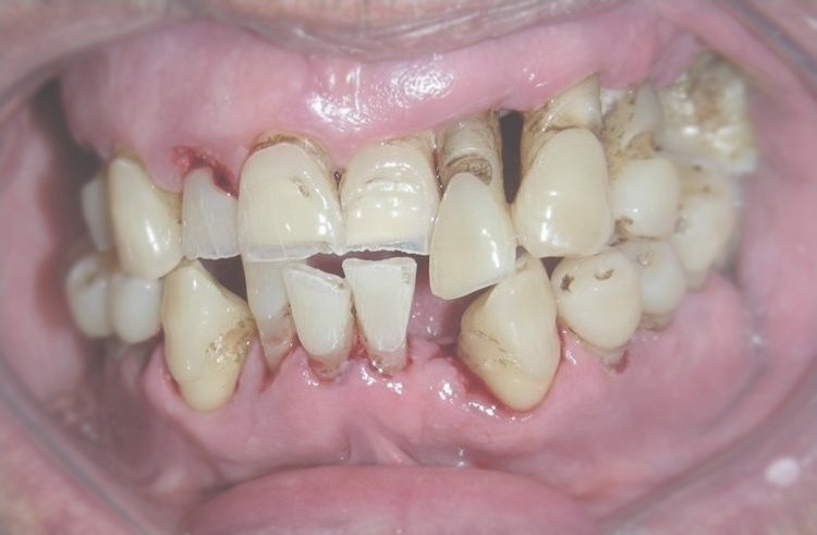 Răng bị lung lay nặng, không thể bảo tồn