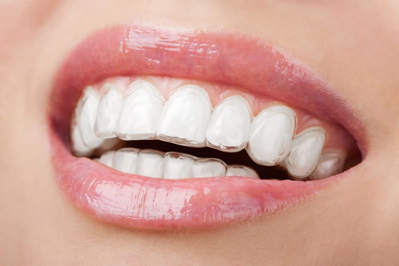 niềng răng trong suốt Invisalign
