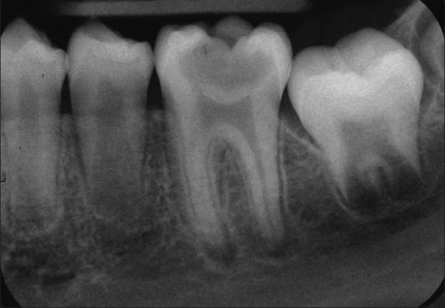 Phim Xquang quanh chóp cho thấy sâu răng đến tuỷ