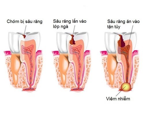 Nguyên tắc điều trị và quy trình lấy tủy răng