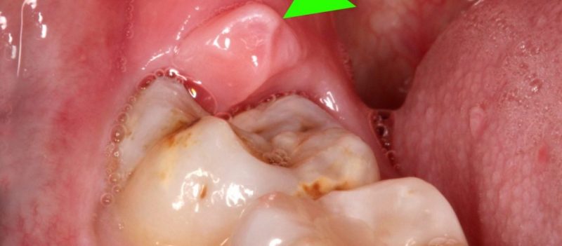 Răng khôn gây đau đớn, khó chịu với nhiều người