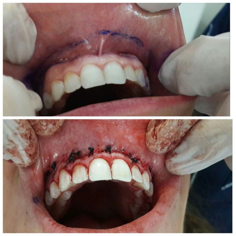 Phẫu thuật định vị lại cơ môi trên