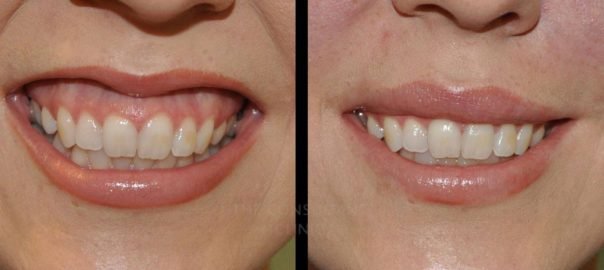 Nguyên nhân nào gây ra cười hở lợi?