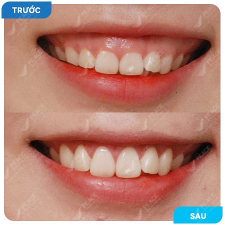 Có những phương pháp nào để điều trị cười hở lợi?