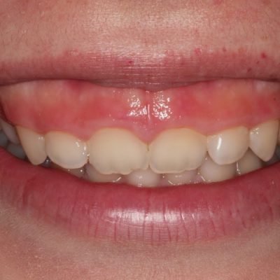 cười hở lợi là gì