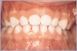 Vào lúc trẻ được 3-4 tuổi hầu hết sẽ có 20 chiếc răng sữa