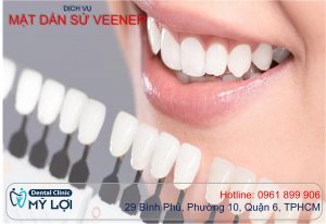 Dán sứ Veneer